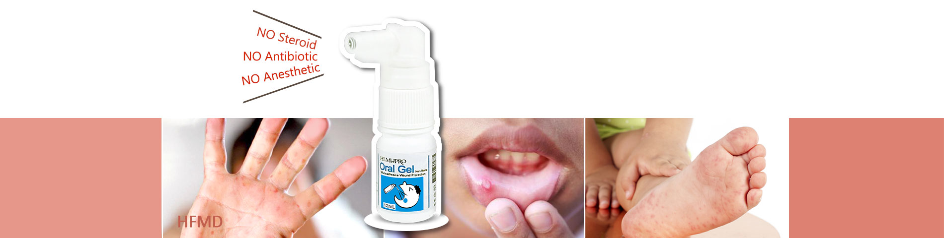 Hand-Foot-Mouth Disease and Oral Ulcers Mouth Wounds Helper oral mucositis aid
